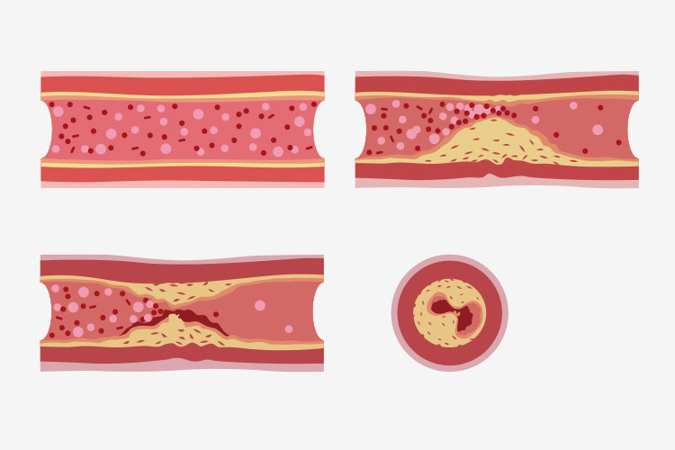 虚血性心疾患のイメージ画像1