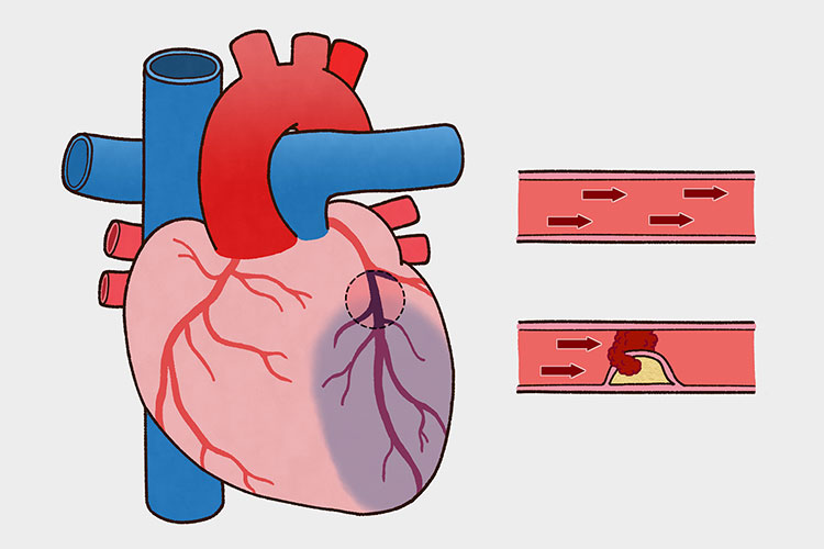 虚血性心疾患のイメージ画像2