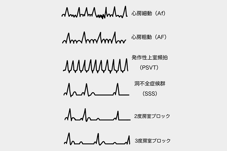 不整脈のイメージ画像1