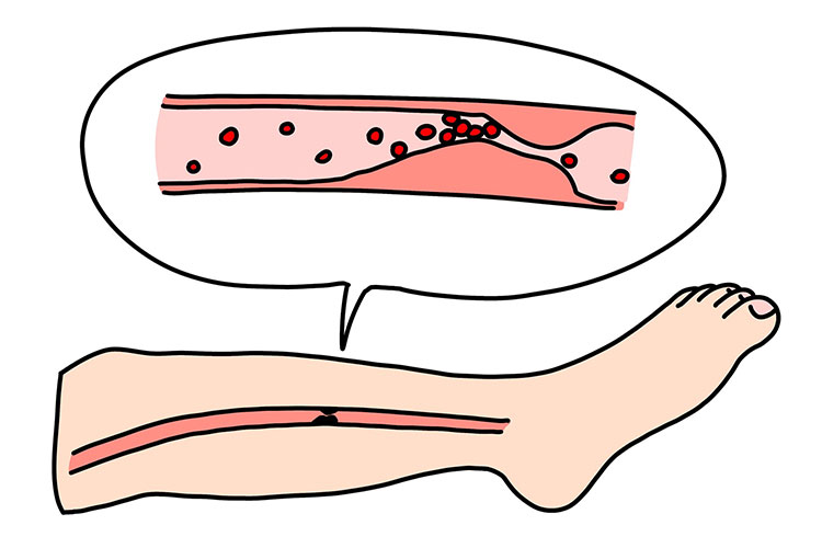 末梢動脈疾患のイメージ画像
