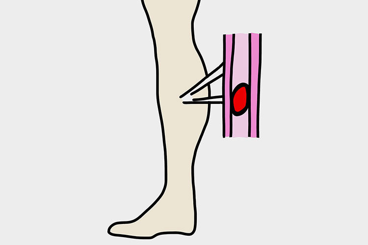 深部静脈血栓症のイメージ画像