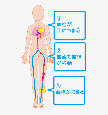 深部静脈血栓症のイメージ画像