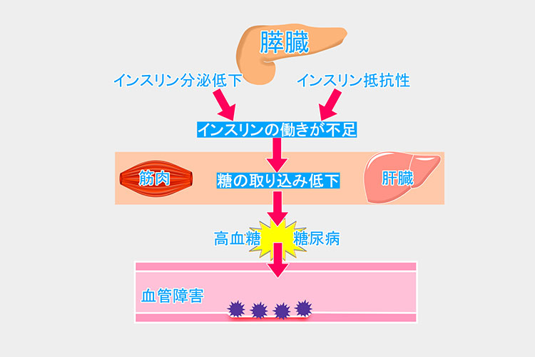 2型糖尿病のイメージ画像