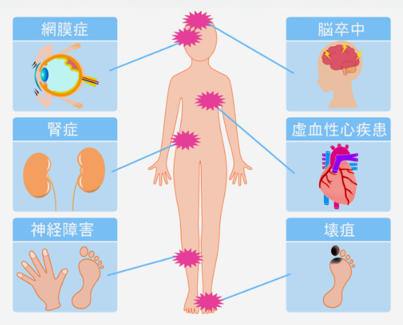 糖尿病治療のイメージ画像