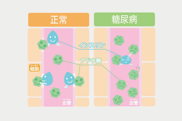 糖尿病のイメージ画像