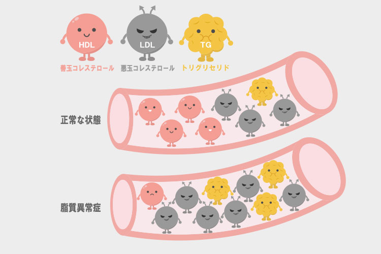 脂質異常症のイメージ画像