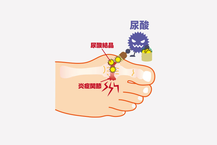 高尿酸血症（痛風）のイメージ画像