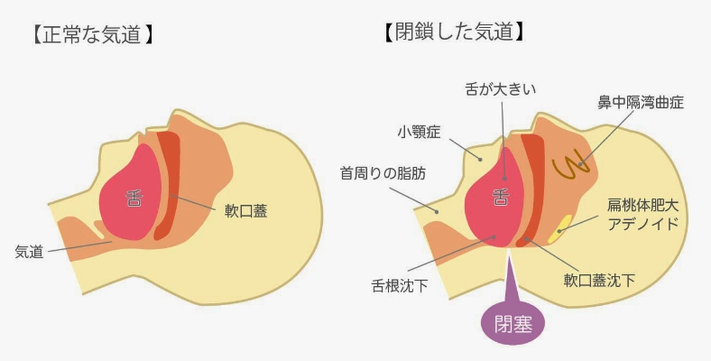 睡眠時無呼吸症候群のイメージ画像
